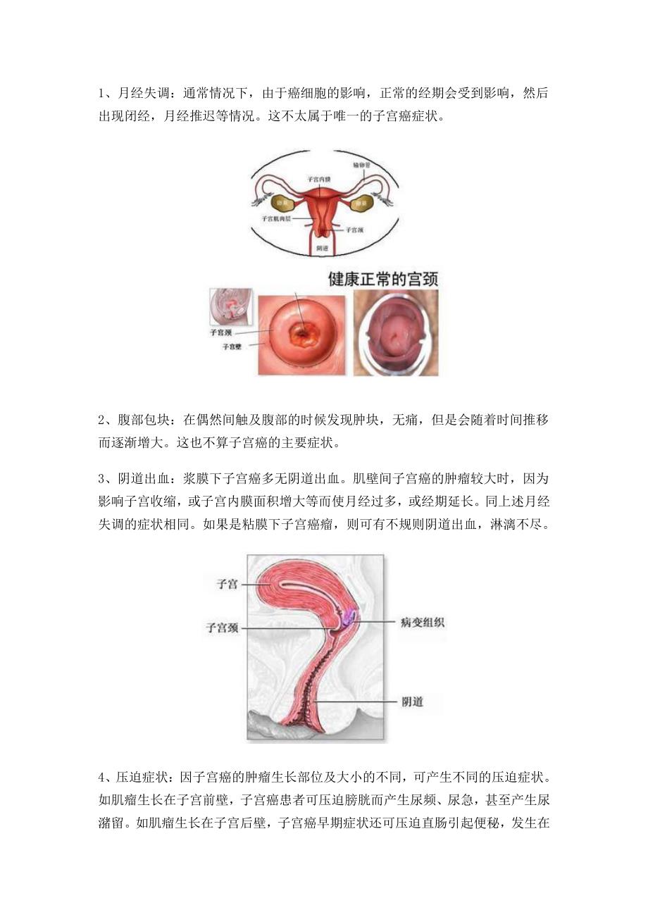 子宫癌的早期症状_第3页