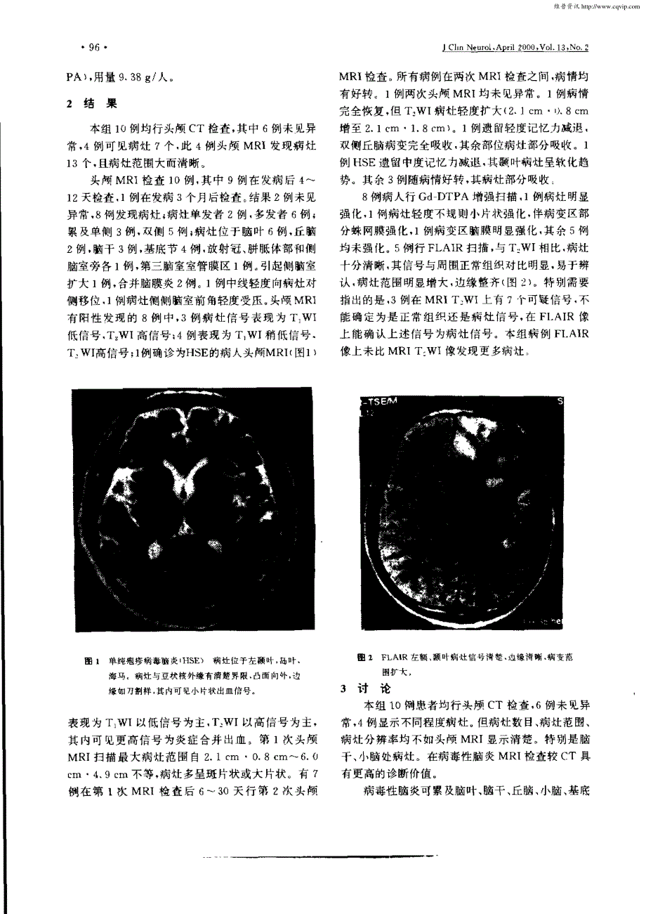 病毒性脑炎的头颅MRI表现_第2页