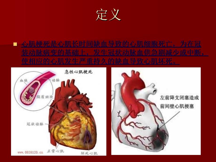 心肌梗塞患者护理_第3页