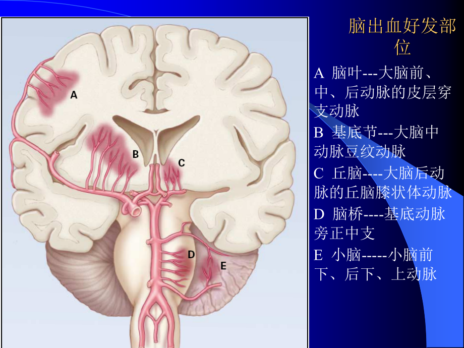 高血压性脑出血的诊断和治疗_第4页