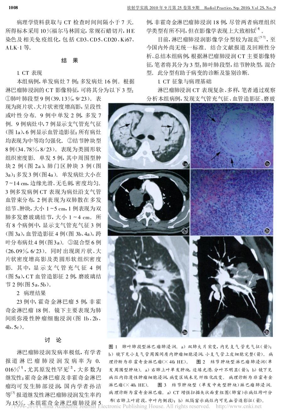 淋巴瘤肺浸润的CT表现和病理对比_曾苗雨_第2页