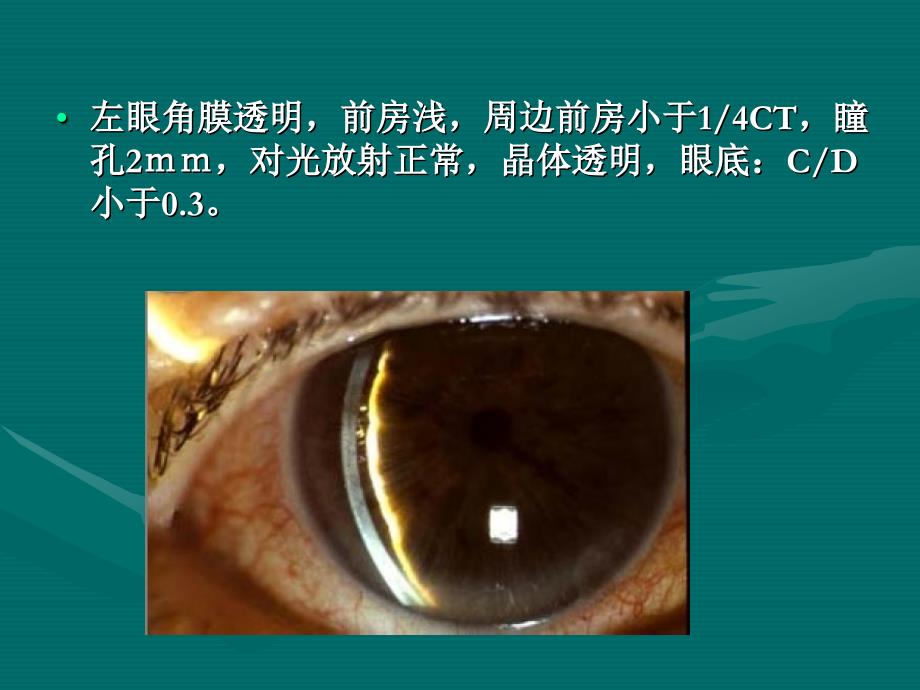 glaucoma示教-孙传宾_第4页