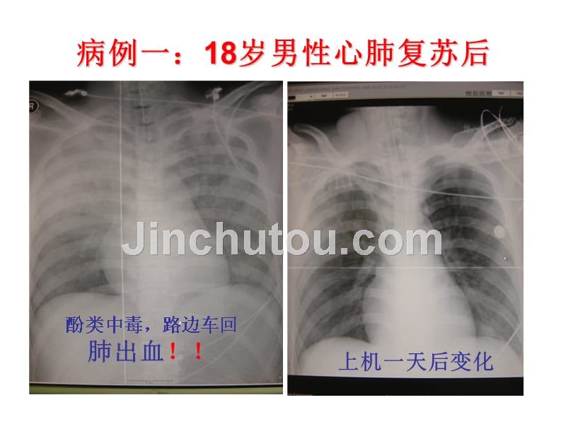 CU患者的肺脏保护-教学课件_第5页