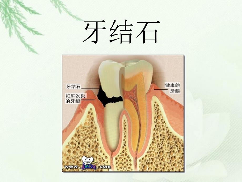 牙齿保健知识讲座_第4页