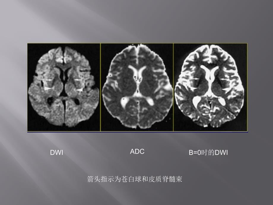 全身类PET肿瘤筛查-正常脑组织的DWI图像_第5页