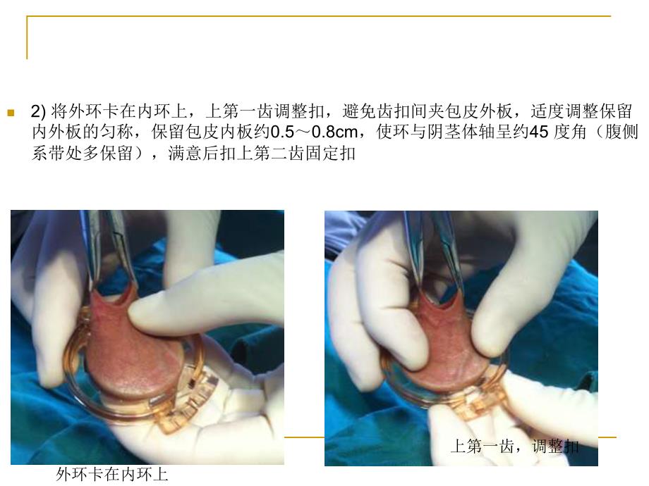 成人商环内置式包皮环切手术步骤_第3页