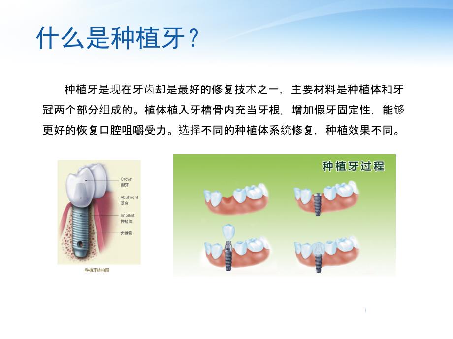 种植牙和烤瓷牙的区别_第2页