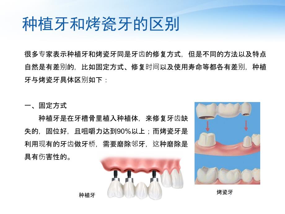 种植牙和烤瓷牙的区别_第4页