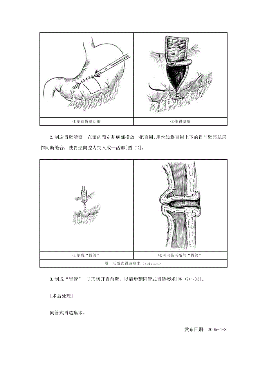 活瓣管式胃造瘘术_第2页