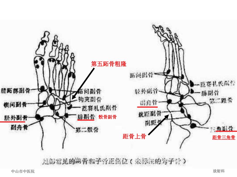 (自制)籽骨、副骨、永存_第3页