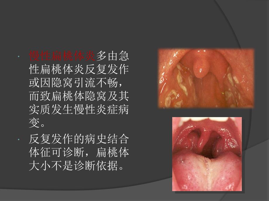 扁桃体切除对IgA肾病的影响_第3页