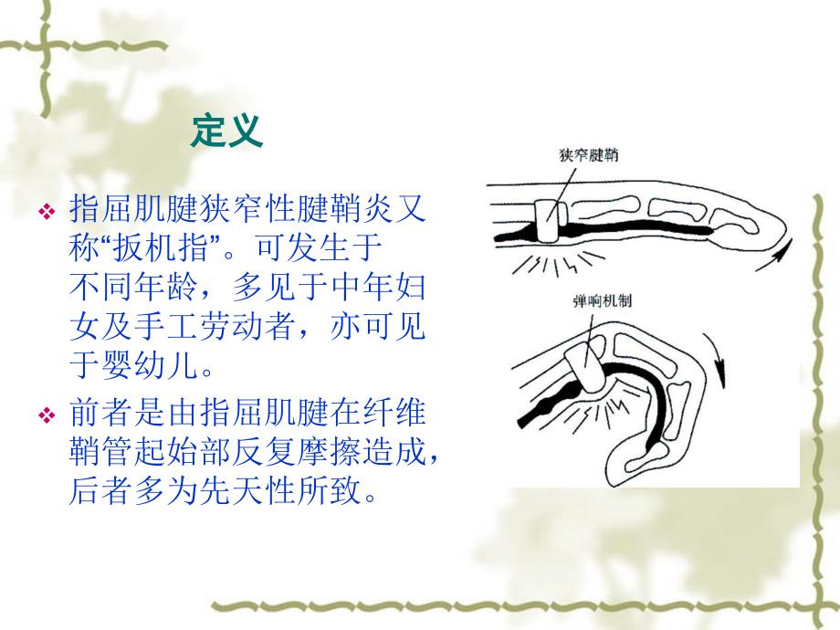 狭窄性腱鞘炎的针刀治疗_第2页