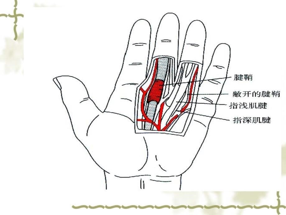 狭窄性腱鞘炎的针刀治疗_第5页