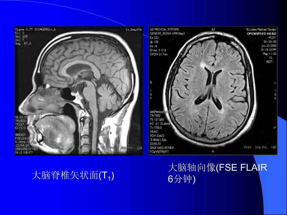 核磁成像讲座2(脑部)_第1页