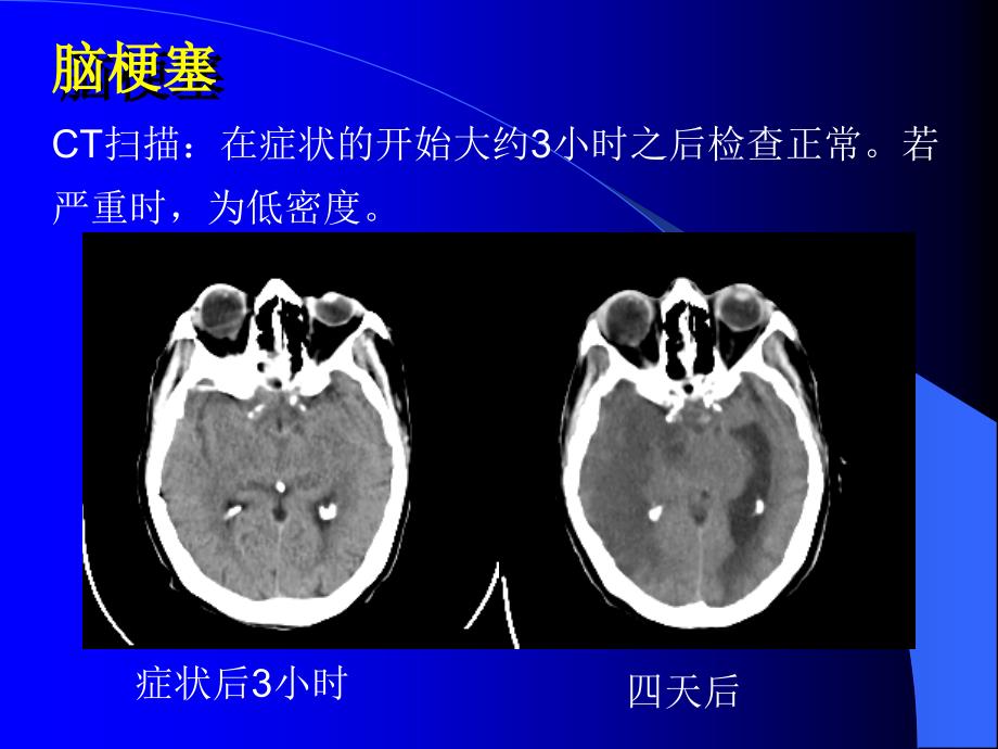 核磁成像讲座2(脑部)_第4页