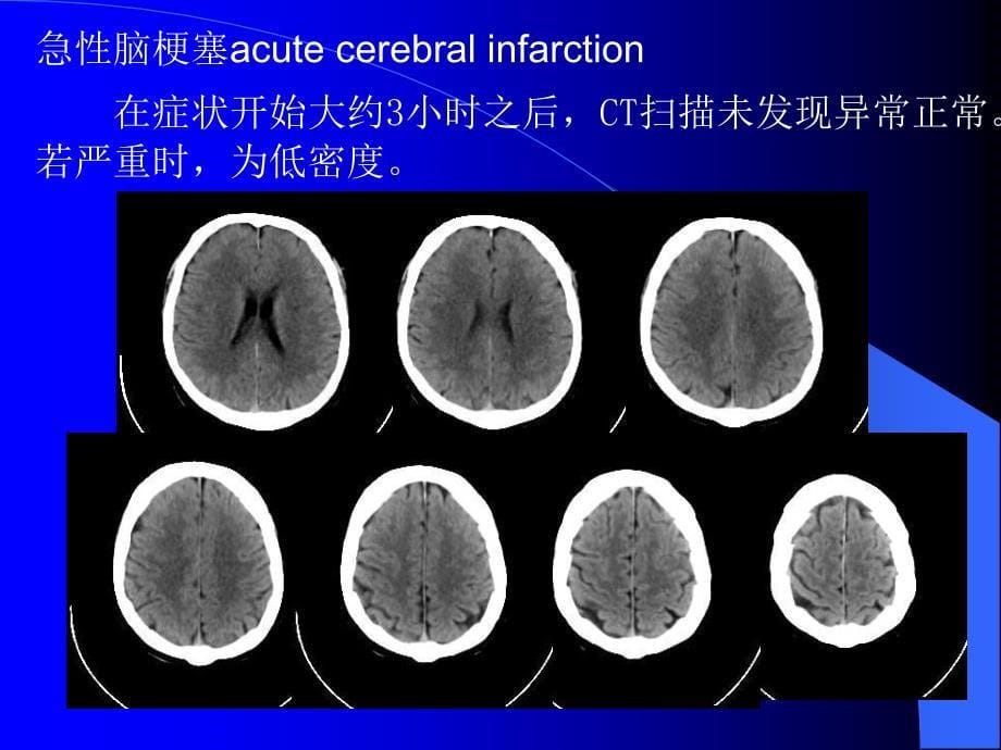 核磁成像讲座2(脑部)_第5页