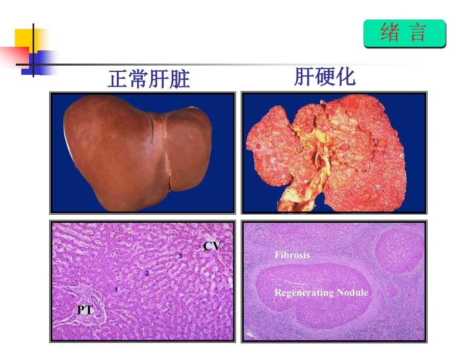 肝硬化治疗的一些进展与共识_第4页