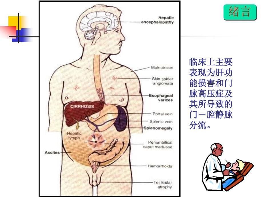 肝硬化治疗的一些进展与共识_第5页