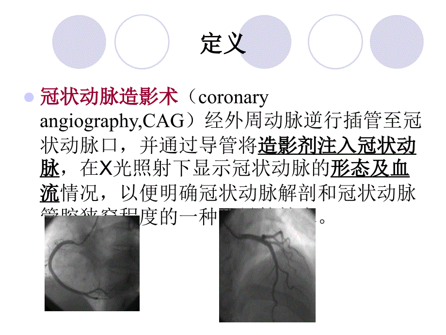 冠脉造影及支架植入术的护理.ppt_第2页