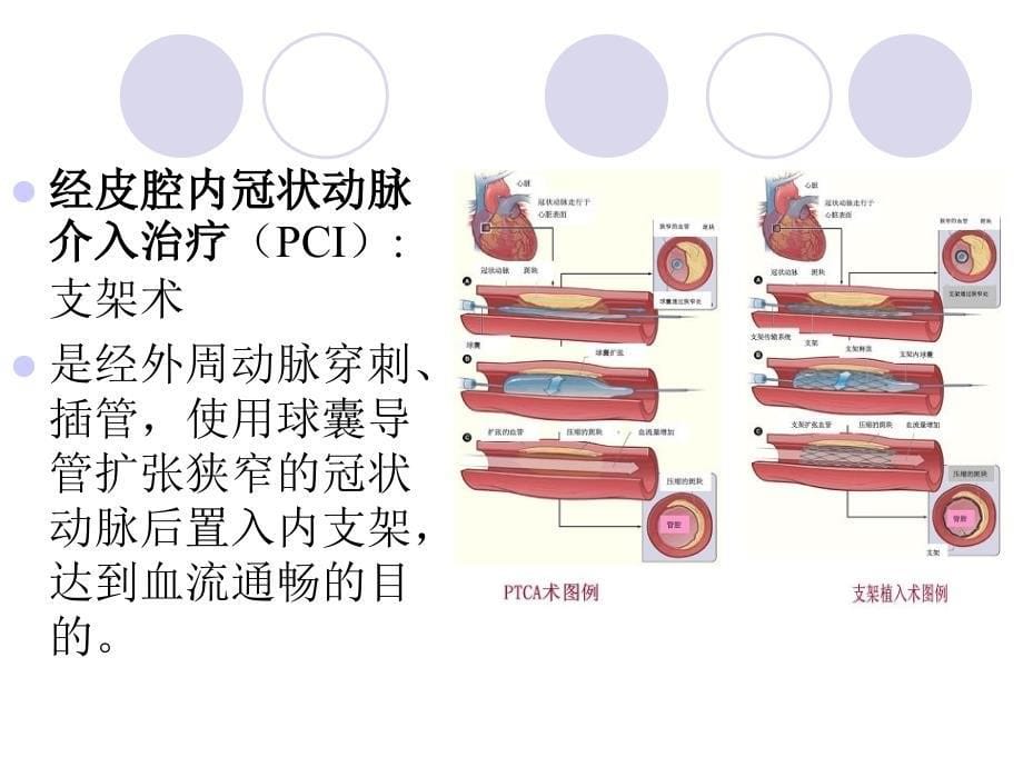 冠脉造影及支架植入术的护理.ppt_第5页