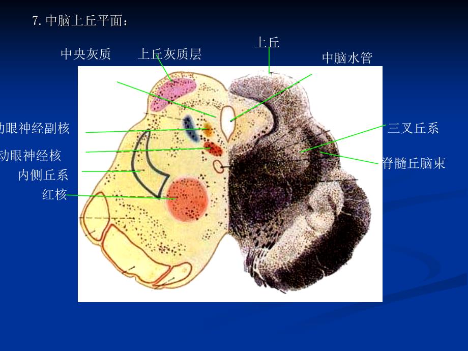 脑干综合症brainstem_syndrom_第2页