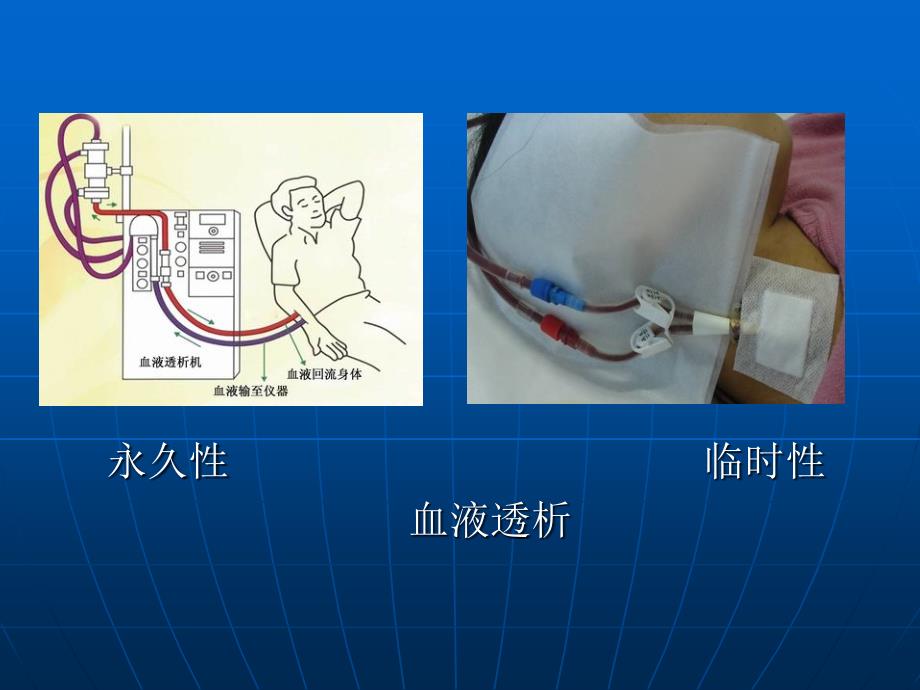 动静脉内瘘护理 ppt课件_第4页