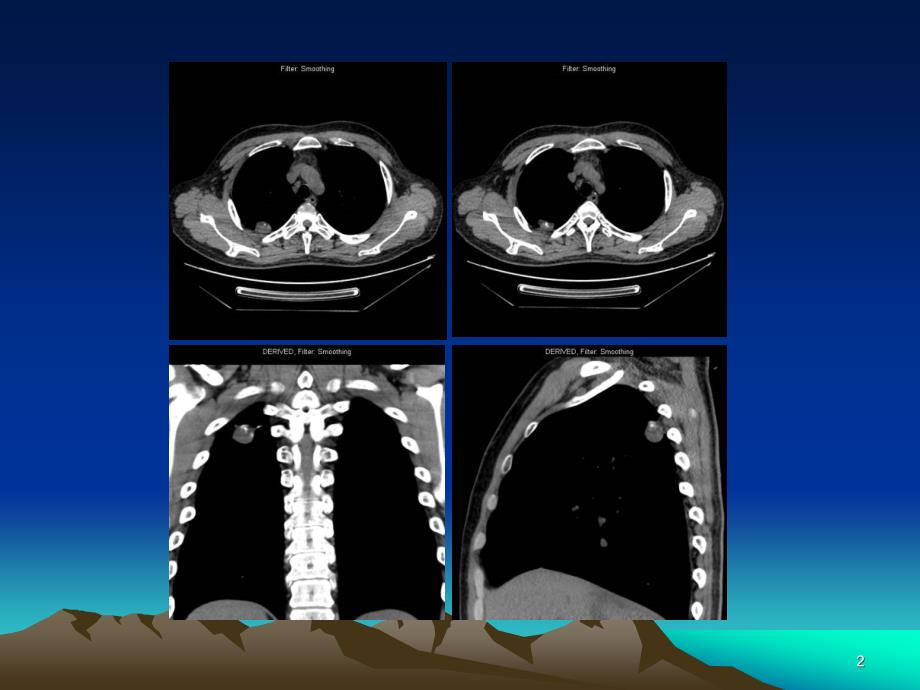 医学ppt--肺错构瘤影像表现_第2页