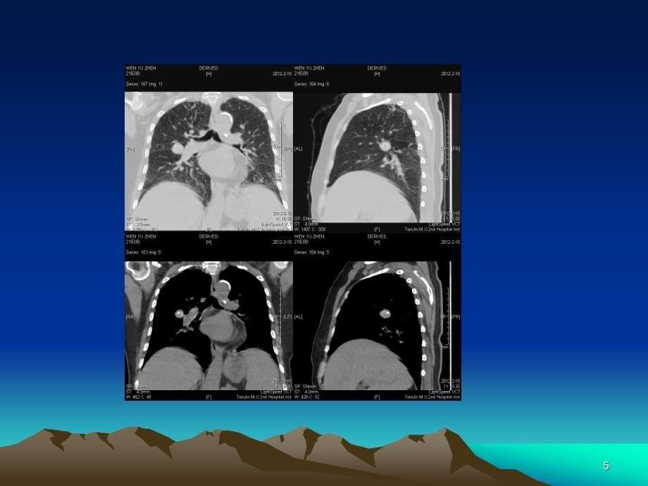 医学ppt--肺错构瘤影像表现_第5页