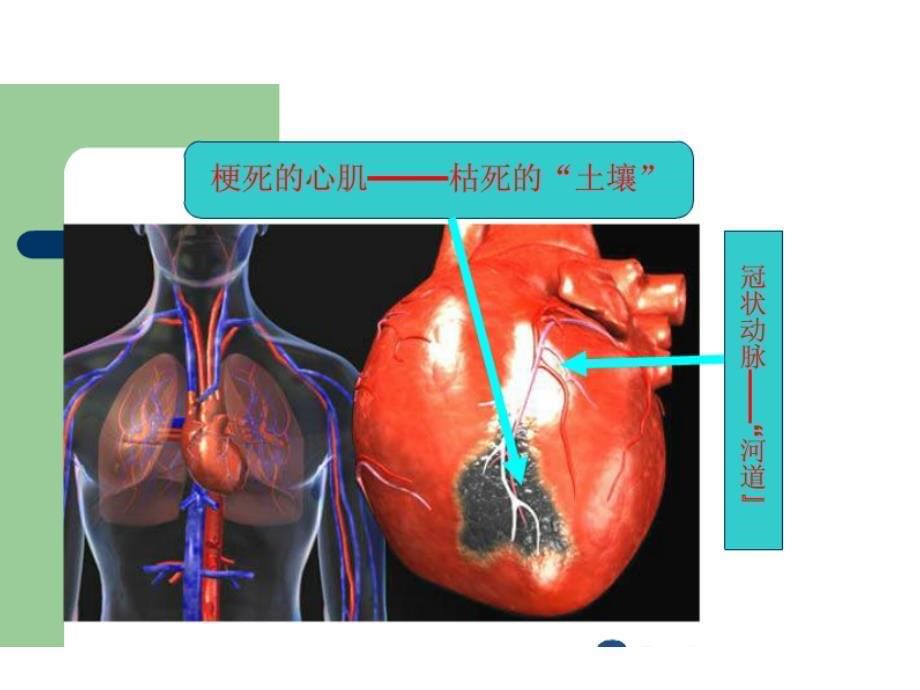 冠心病健康教育 ppt课件_第5页