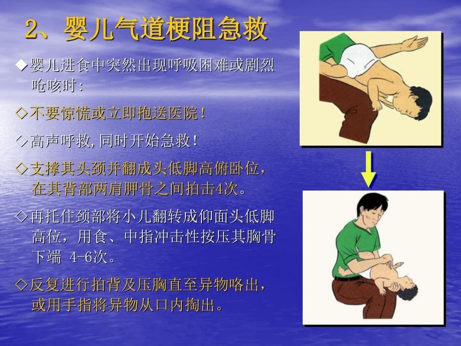 气道异物梗塞与溺水急救_第5页