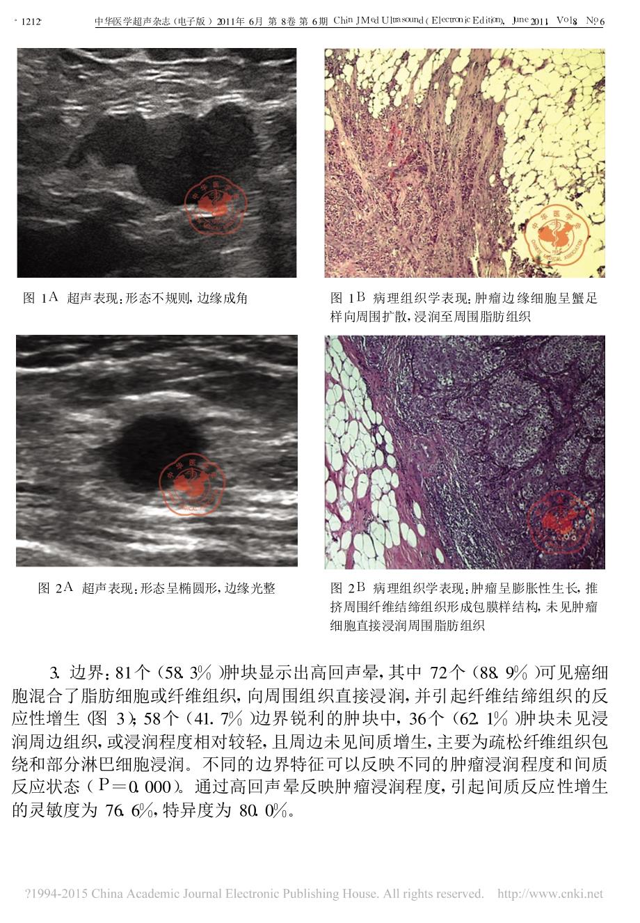 乳腺癌超声表现与其病理基础的相关性研究_张静雯_第4页