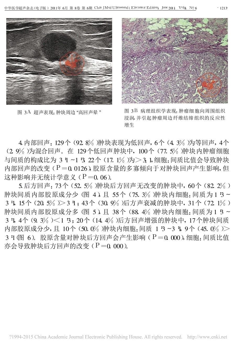 乳腺癌超声表现与其病理基础的相关性研究_张静雯_第5页