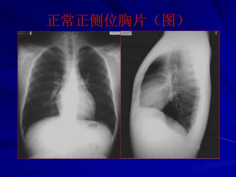 正常正侧位胸片(图_第1页