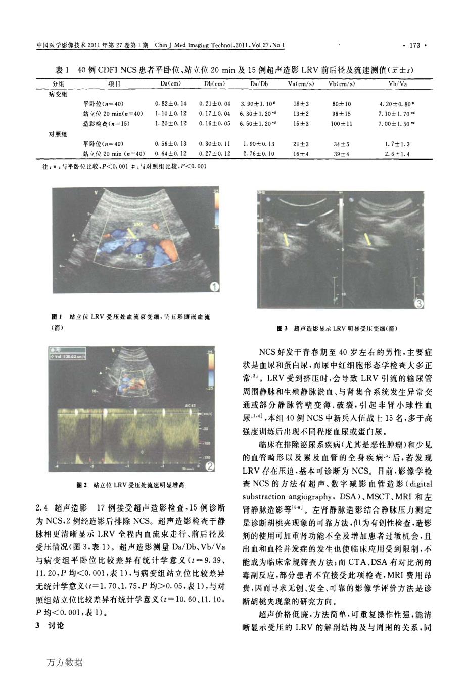 彩色超声多普勒结合超声造影诊断胡桃夹综合征_第3页