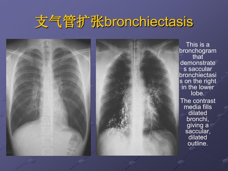 支气管扩张症及咯血护理需要_第3页