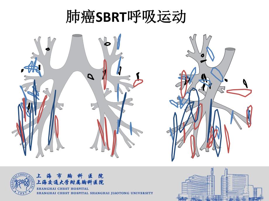 肺癌的呼吸运动控制讨论_第3页