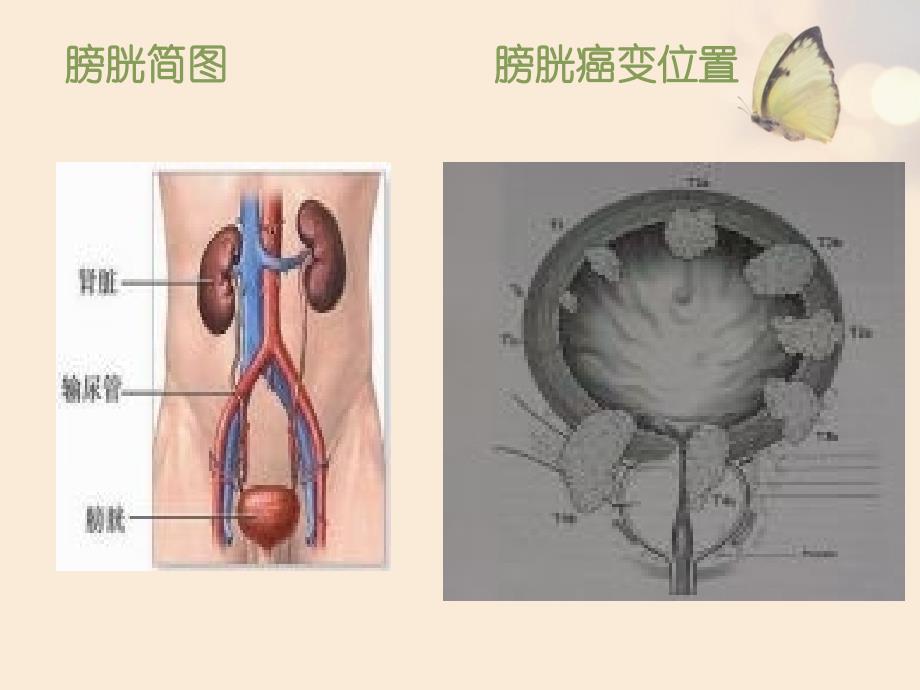 膀胱癌术后病员的术后护理 ppt课件_第4页