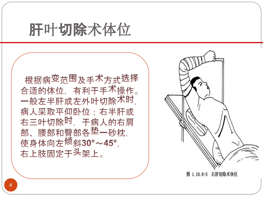 肝叶切除术围手术期的护理 ppt课件_第4页