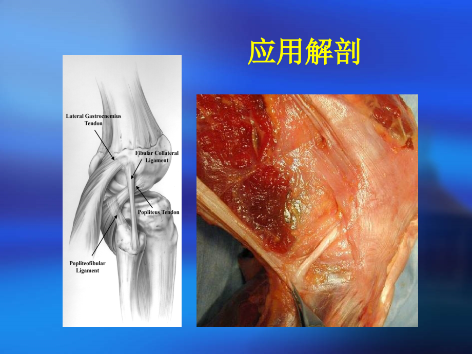 膝关节后外侧韧带结构损伤课件ppt_第3页