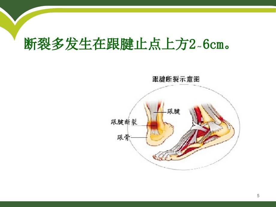 跟腱锻炼术后康复训练_第5页