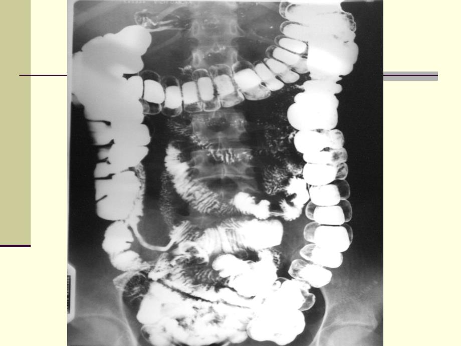 大肠疾病影像学诊断幻灯片_第2页