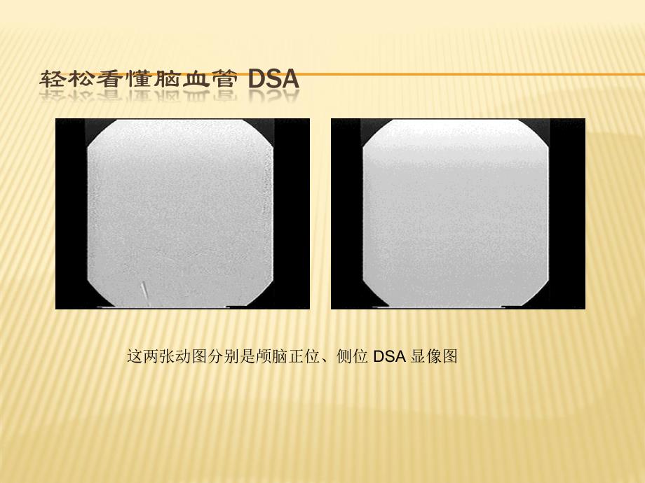 DSA全脑血管造影术PPT课件_第1页