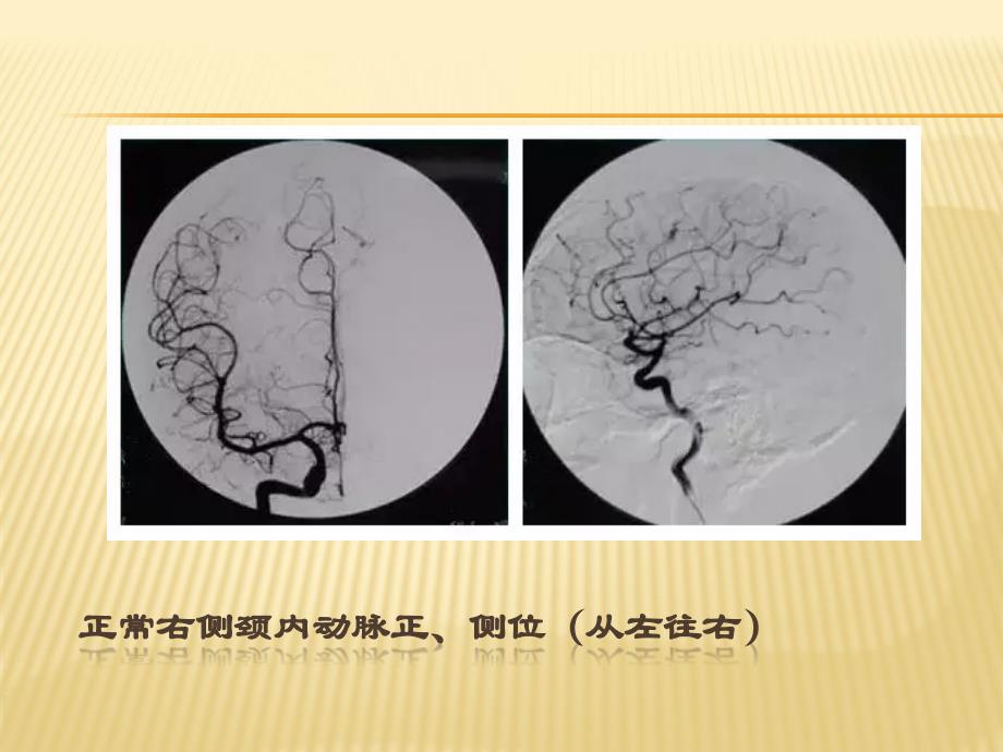 DSA全脑血管造影术PPT课件_第4页