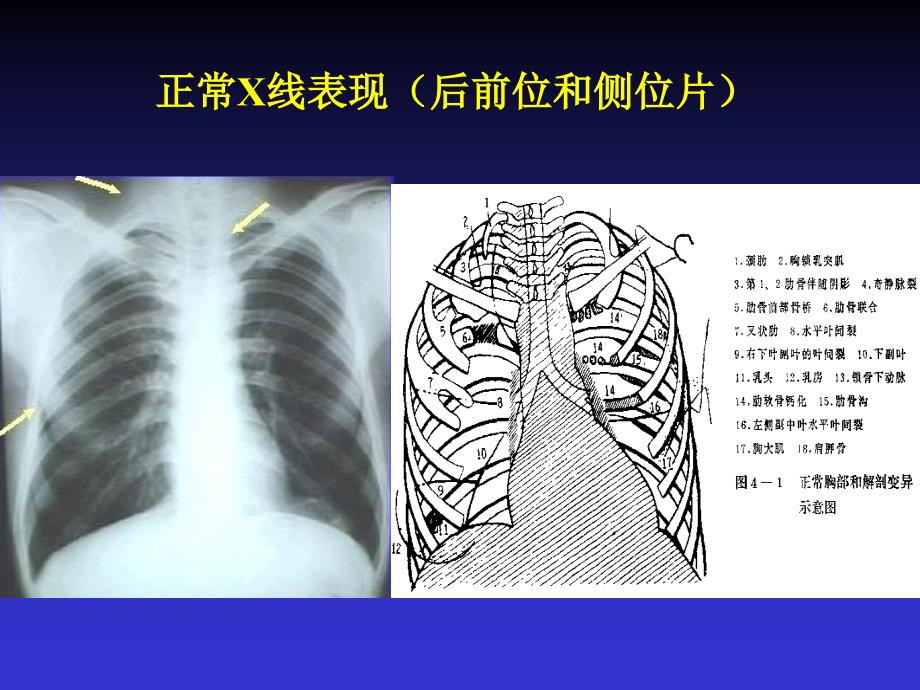 呼吸系统X线诊断ppt课件_第2页