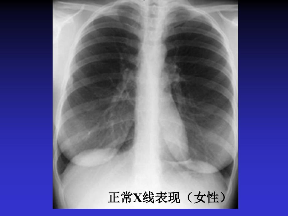 呼吸系统X线诊断ppt课件_第3页
