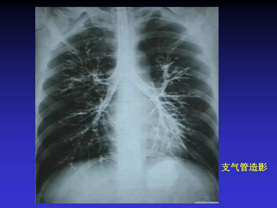 呼吸系统X线诊断ppt课件_第4页