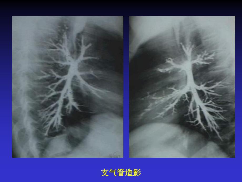 呼吸系统X线诊断ppt课件_第5页