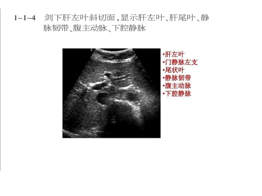 肝胆超声解剖课件_第5页