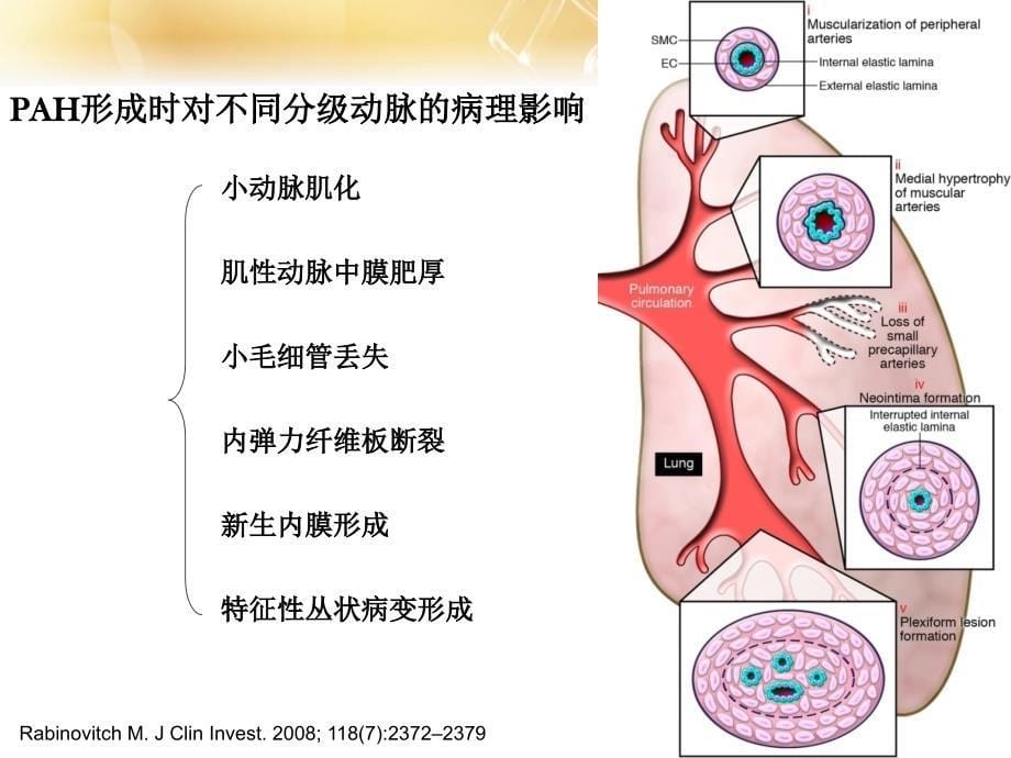 肺动脉高压临床诊治进展PPT课件_第5页