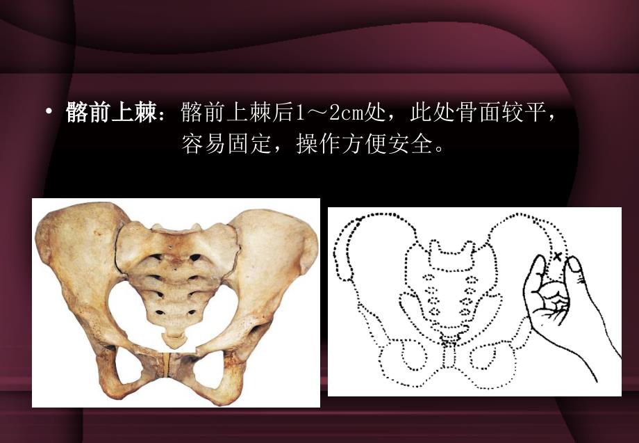 骨髓穿刺术ppt医学幻灯片_第4页